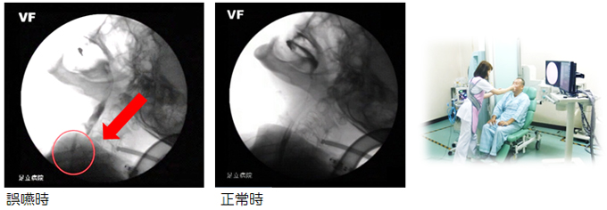 嚥下造影検査を用いた誤嚥対策